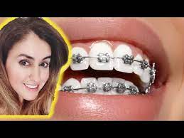 hacks for whiter teeth with braces