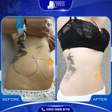 liposuction and lipo injections 4
