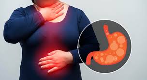 acid reflux 12 easy home remes to