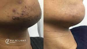 Unlike other methods such as waxing and shaving laser hair removal gives long lasting results.the hair will become finer and softer meaning less visible and the. Laser Hair Removal London Pulse Light Clinic London