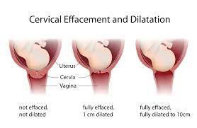 cervical effacement what you need to know