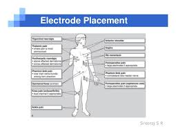 Transcutaneous Electrical Nerve Stimulation Tens