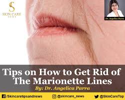 marionette lines and wrinkles