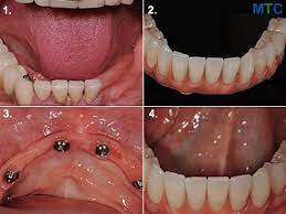 Medical Tourism Dental Implants gambar png