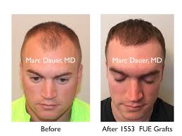 Just like your old hair, you can dye, perm, and cut your transplanted hair with no worries. Hair Loss Doctor Santa Monica Ca Hair Transplant Doctor Los Angeles