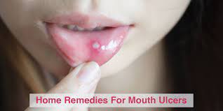 home remes for mouth ulcers