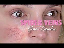 spider veins eczema more home