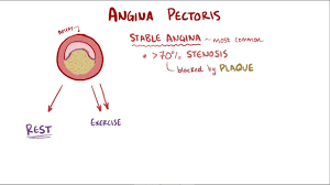 Myocardial infarction vs stable angina. Angina Pectoris Stable Unstable Prinzmetal Vasospastic And Symptoms Youtube
