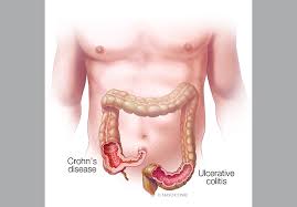 Ulcers form where inflammation has killed the cells that usually line the colon, then bleed and produce pus. Advances In The Treatment Of Crohn S Disease And Ulcerative Colitis Mayo Clinic
