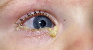 conjunctivitis in es and toddlers