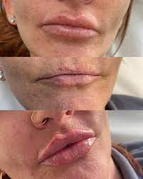 migrated lips or poorly placed filler