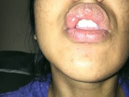 big bubble on lip after anesthesia