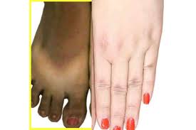 i am light skinned but have dark feet