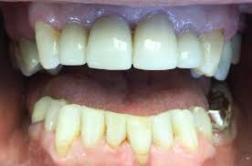 crowns and tooth colored fillings