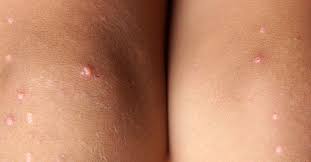 pimples on legs causes and treatment