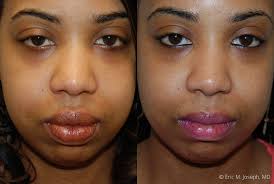 eric m joseph md lip reduction