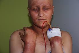chemotherapy induced acral erythema
