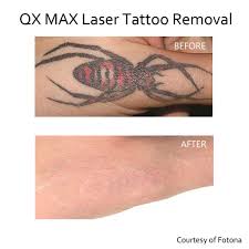 laser tattoo removal nyc garden