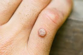 how to get rid of a wart for good