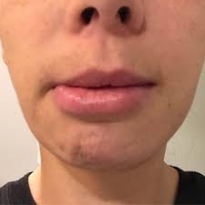 droopy lower lip 4 weeks after jaw