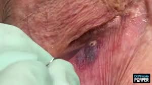 Biggest pimple in the world is about to be popped and we do the popping! Dr Pimple Popper See The Biggest Blackhead Ever Sitting On An Eyeball