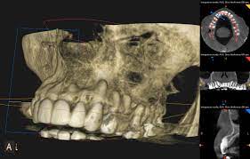 why cbct cone beam ct scan is a must