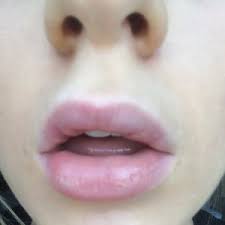 py lips after lip fillers 3 days ago