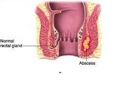 abscess fistula causes