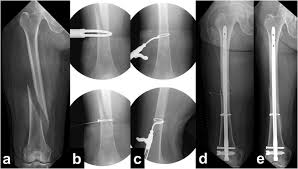 infra isthmal fem fracture