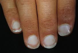 What Your Fingernails Say About Your Health Ridges Spots