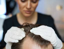 hair loss dermafrica
