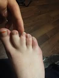 My friends toe(s). : r/mildlyinteresting