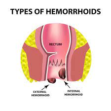 hemorrhoids types symptoms causes