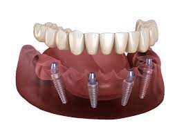 permanent teeth cost 29 995 vaughan