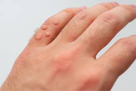 how to get rid of warts at home 7 tips