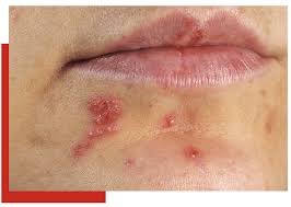 There's also a much higher frequency of asymptomatic shedding of the virus in hsv 2 (genital herpes) then in hsv 1. Herpes Simplex Sutton Dermatology Aesthetics Ctr