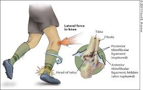 A grade 2 ankle sprain is considered a moderate injury. Management Of Ankle Sprains American Family Physician