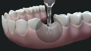 Dental Implant Dark High Quality Animation 3d Showing The Installation Process Of Dental Implants