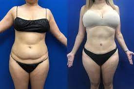 do you lose weight with liposuciton