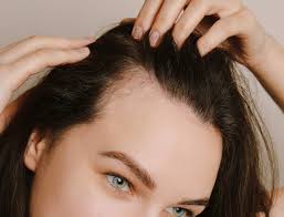 hair loss from alopecia areata