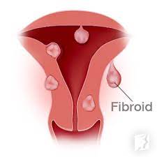 uterine fibroidenopause