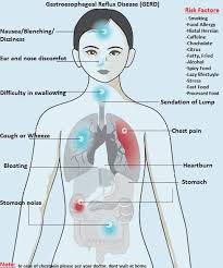 gerd gastroesophageal reflux disease