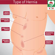 Type Of Hernia A Hernia Has A Various Type And It Occurs