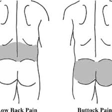 Pertaining to the lower back or loin region; The Schematic Diagram Explaining The Areas Of Low Back Pain And Buttock Download Scientific Diagram