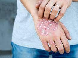 psoriasis on hands causes and treatment