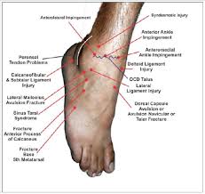 Your diagnosis is a grade ii or iii sprain of the medial collateral ligament (mcl). Persistent Pain After Lateral Ankle Sprain A Diagnostic And Treatment Dilemma A Review Article