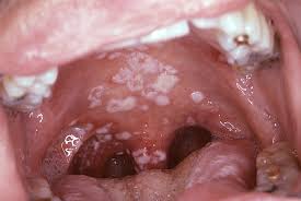 white patches of the mucosa