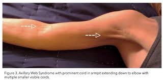 lymphoedema and cording the science