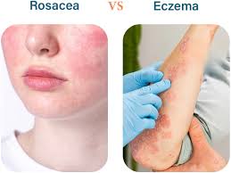 rosacea vs eczema common skin