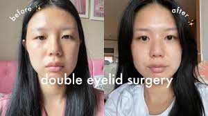 hana lee got double eyelid surgery r